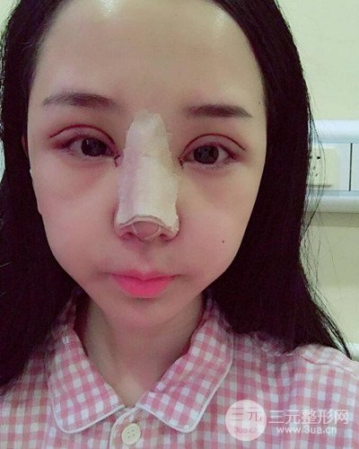 深圳蒳美迩朱灿医生眼隆鼻整形案例分享，附上前后对比照~