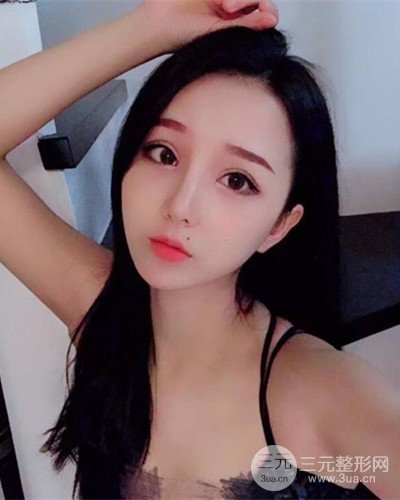 深圳蒳美迩朱灿医生眼隆鼻整形案例分享，附上前后对比照~