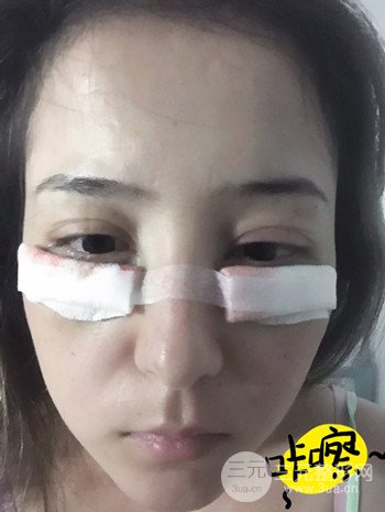 广州内切去眼袋术后恢复过程案例对比分享