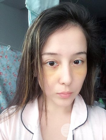 广州内切去眼袋术后恢复过程案例对比分享