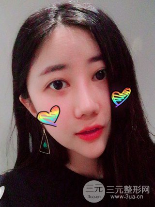 深圳臻希美详细部自体脂肪填充果对比超明X