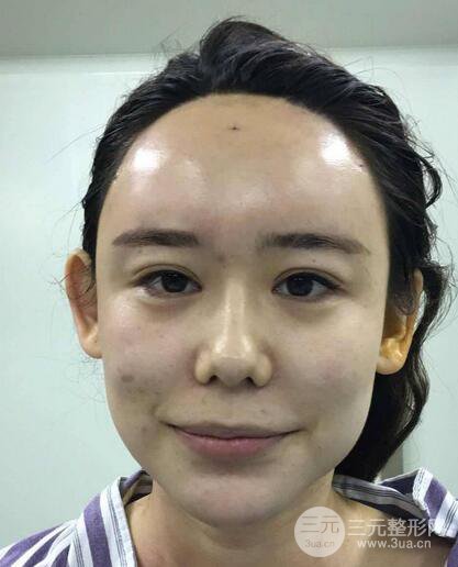 全脸自体脂肪填充，填充不饱满还可以瘦脸_真人案例