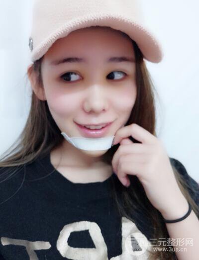 全脸自体脂肪填充，填充不饱满还可以瘦脸_真人案例