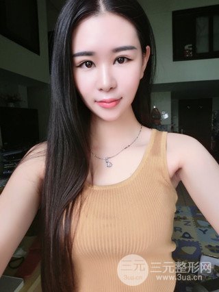 深圳全切双眼皮修复成功案例恢复过程分享