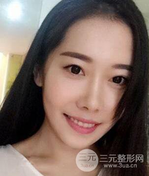 颧骨磨骨改脸型过程和恢复步骤照片（图）