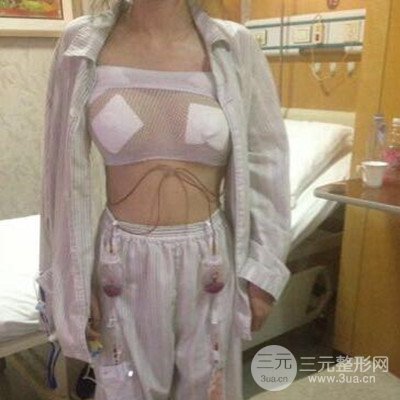 无锡丽都储刚假体隆胸案例前后对比图分享