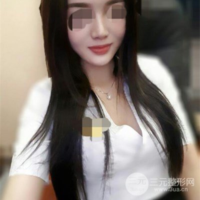无锡丽都储刚假体隆胸案例前后对比图分享