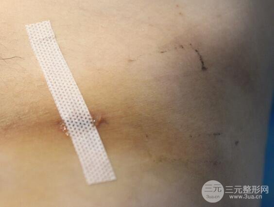 九院曹卫刚自体脂肪面部填充案例