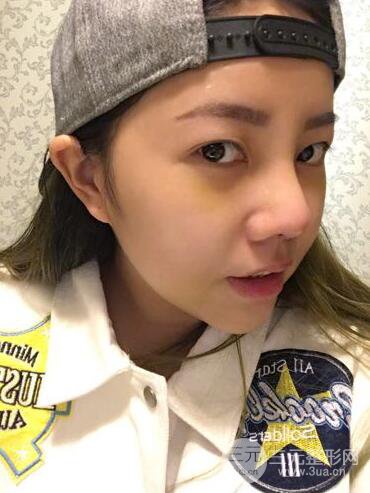 西安西京医院整形科潘勇隆鼻整形案例以及前后对比图展示~