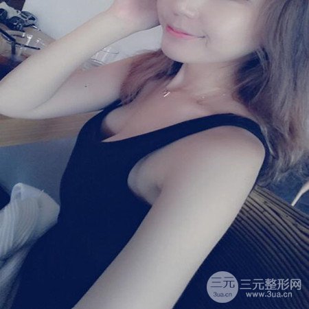 广东省第二人民医院罗盛康假体隆胸前后对比案例