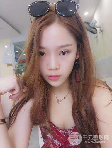 深圳朱武根双眼皮案例术后恢复果记录