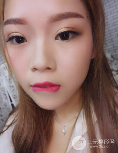 深圳朱武根双眼皮案例术后恢复果记录