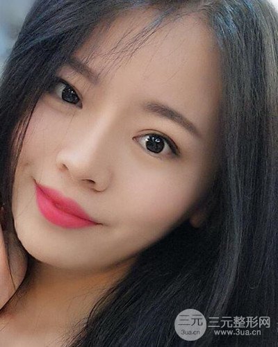 苏州美莱尹飞隆鼻整形案例，前后恢复图分享~