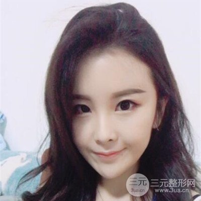 济南伊美尔整形王飏自体脂肪面部填充案例前后对比