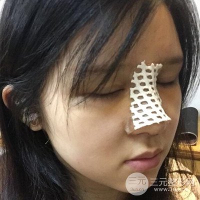 北京叶子整形鲁礼新隆鼻整形案例前后对比图分享