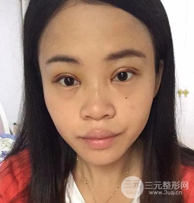 常州一院王德伟双眼皮恢复日记实记