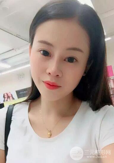 常州一院王德伟双眼皮恢复日记实记
