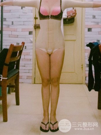 济南腰腹吸脂案例三个月前后变化图片分享