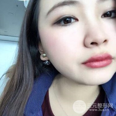 西安高一生金磊隆鼻整形案例前后对比图