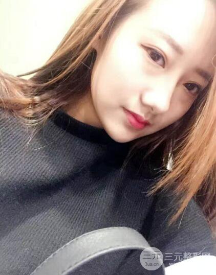 西安西美张丽双眼皮案例图片分享