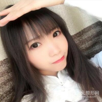 张永义医生全切双眼皮案例前后对比图