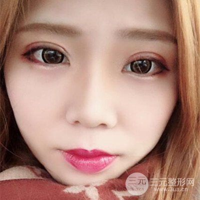 无锡菲尚徐火旺双眼皮案例前后对比图