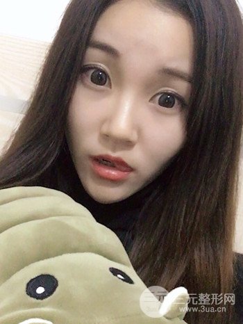 济南硅胶假体垫下巴真人案例、下巴改变整个脸型