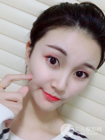 济南硅胶假体垫下巴真人案例、下巴改变整个脸型