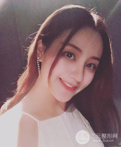 顾陆健做鼻子隆鼻案例术后恢复果分享