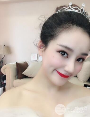 顾陆健做鼻子隆鼻案例术后恢复果分享