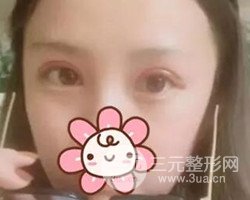 南京鼓楼谭谦医生切开双眼皮案例，恢复图分享~