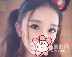 南京鼓楼谭谦医生切开双眼皮案例，恢复图分享~