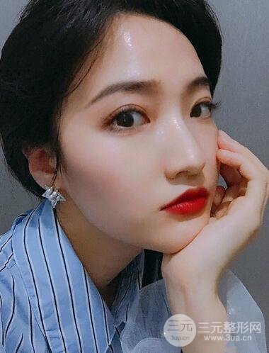 重庆华美何春涛双眼皮案例图片恢复记录