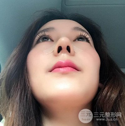 成都华颜黄富伟自体软骨隆鼻案例前后对比图分享