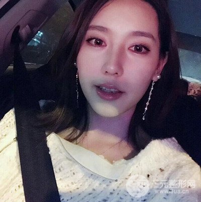 成都华颜黄富伟自体软骨隆鼻案例前后对比图分享