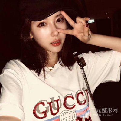 成都华颜黄富伟自体软骨隆鼻案例前后对比图分享