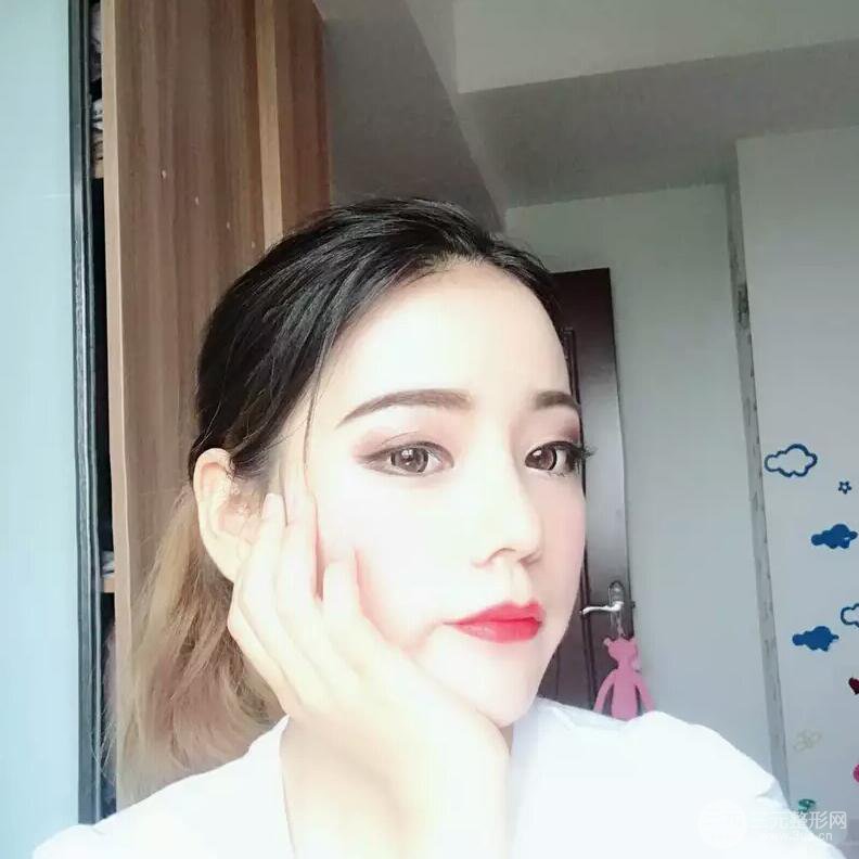 硅胶隆鼻+自体耳软骨垫鼻尖案例前后对比照片分享