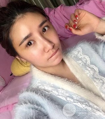 网络主播做自体脂肪丰太阳穴真实案例分享，果杠杠的