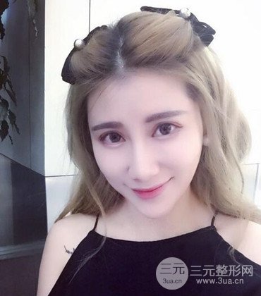 网络主播做自体脂肪丰太阳穴真实案例分享，果杠杠的