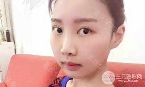 重庆华美潘宝华磨骨怎么样?整形案例恢复图片分享