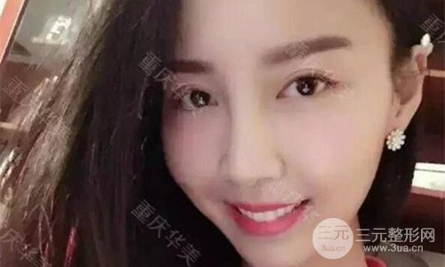 重庆华美潘宝华磨骨怎么样?整形案例恢复图片分享