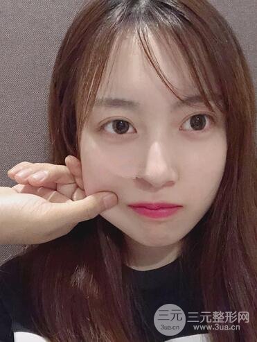 华美许再荣双眼皮案例恢复果,闭眼微创~