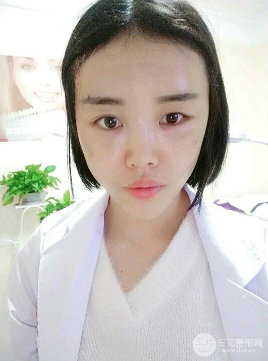 成都军大钟正强自体脂肪填充面部案例恢复图，马上变成“初恋脸”