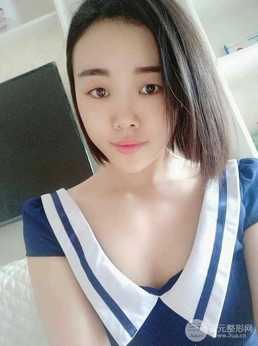 成都军大钟正强自体脂肪填充面部案例恢复图，马上变成“初恋脸”