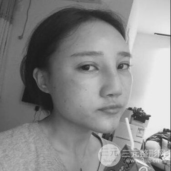 甘海平自体脂肪填充面部+隆鼻整形对比过程恢复感想