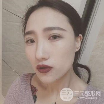 甘海平自体脂肪填充面部+隆鼻整形对比过程恢复感想
