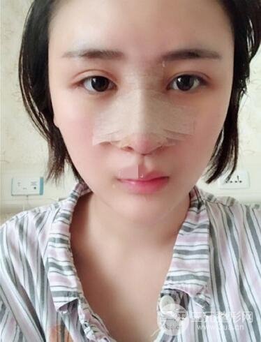 上海李鸿君隆鼻果图片恢复日记分享