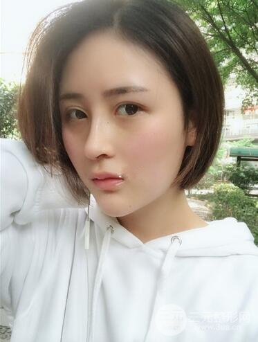 上海李鸿君隆鼻果图片恢复日记分享