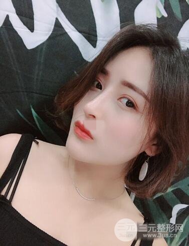 上海李鸿君隆鼻果图片恢复日记分享