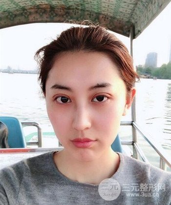 苏州切开双眼皮恢复果大分享，变化不止一点点
